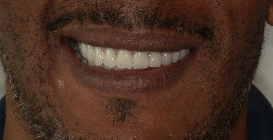 Full-mouth dental implant patient before treatment