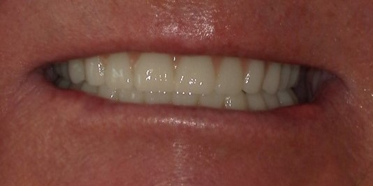 Dental implant patient after treatment