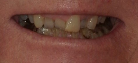 Dental implant patient before treatment