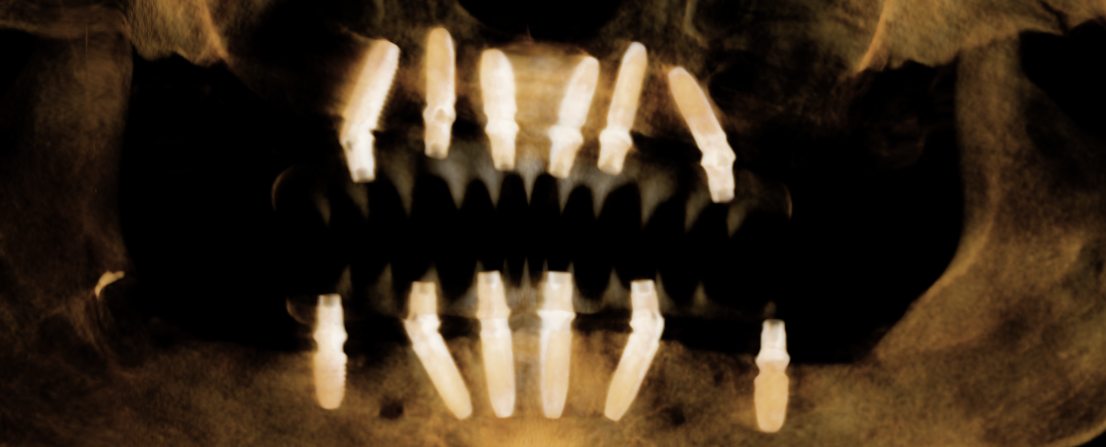 Panoramic x-ray after dental implant treatment