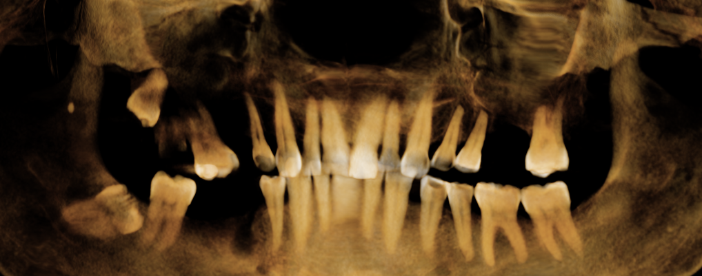 Panoramic x-ray before dental implant treatment