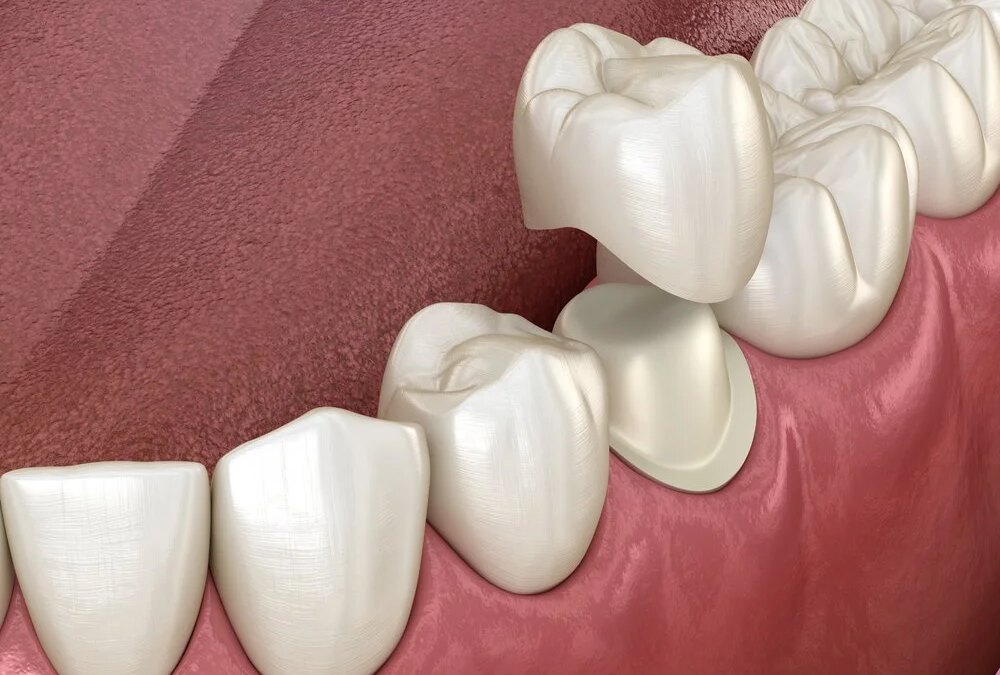 Is a Dental Crown Helpful to Restore Your Smile?