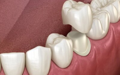 Is a Dental Crown Helpful to Restore Your Smile?