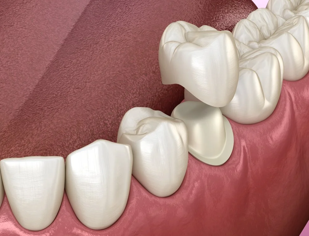 Cosmetic dentistry and dental crown treatment in Oklahoma City