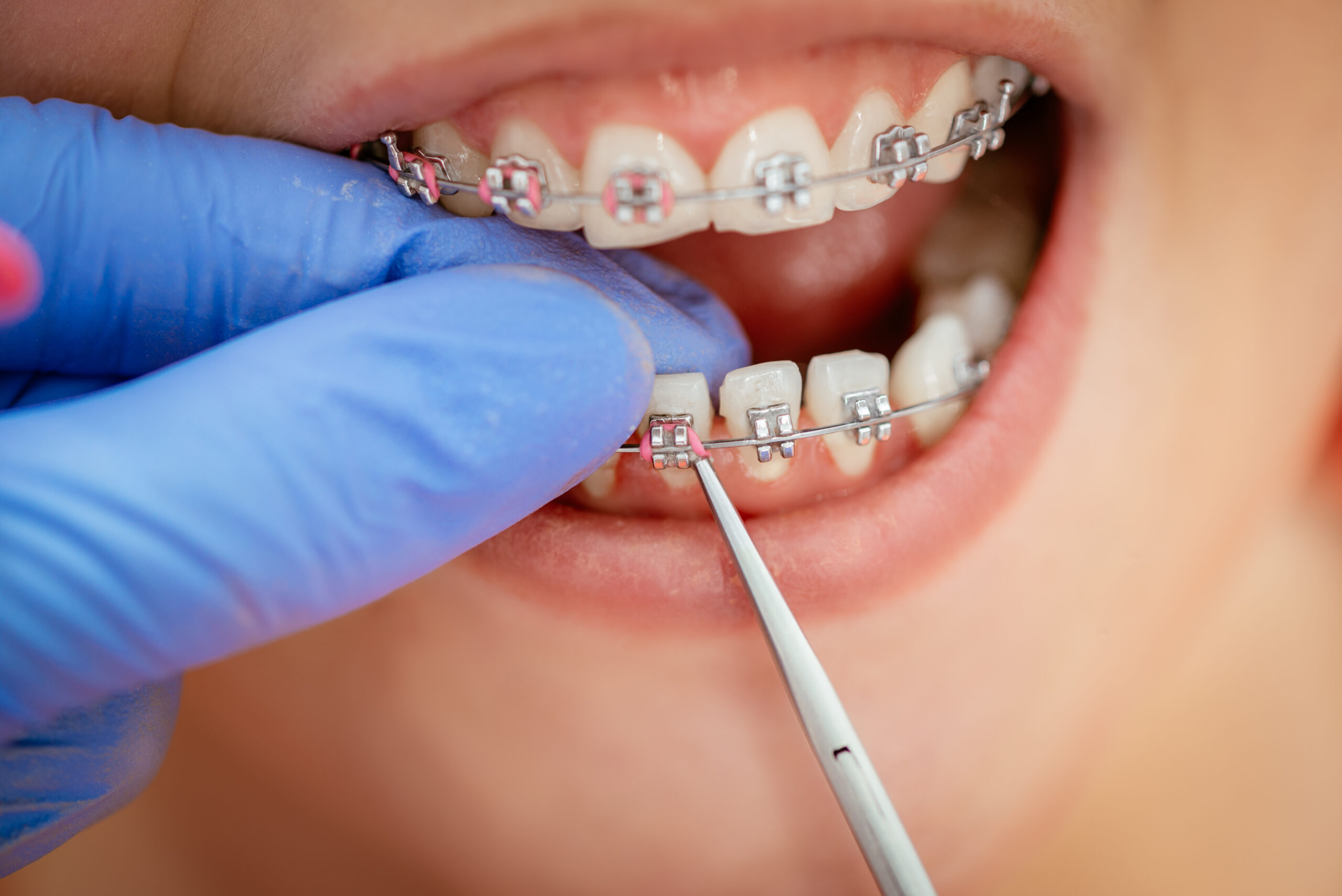 Patient receiving orthodontic treatment