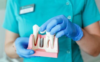 The Cost of Dental Implants to Know Before You Go