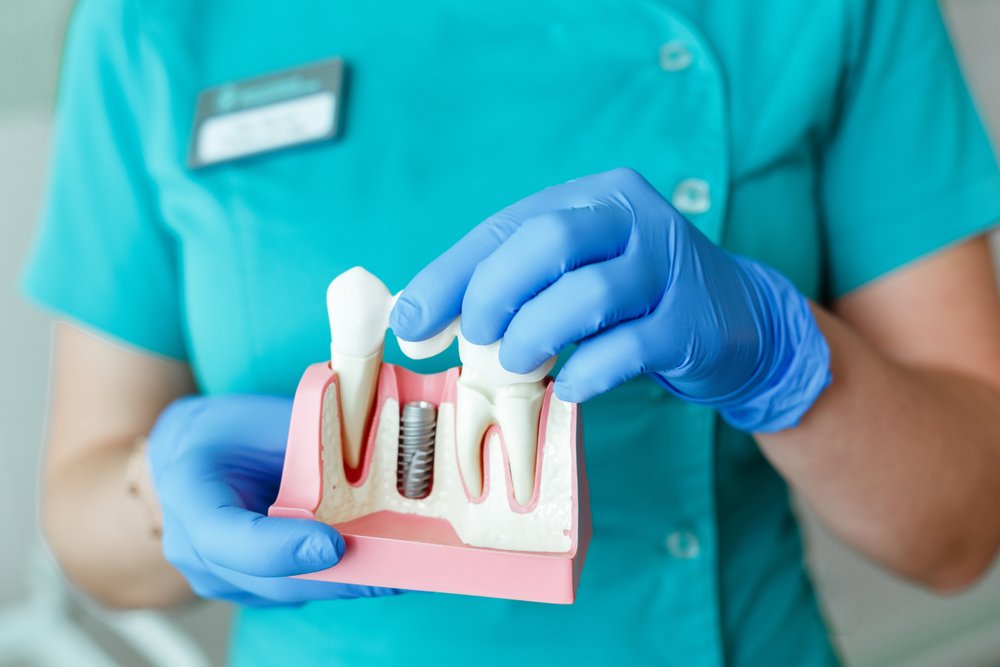 Dental implant model held by a dental professional