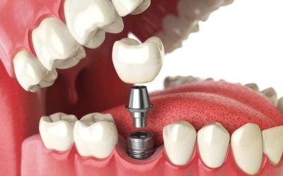 Some Choices of Dental Implants for Patients