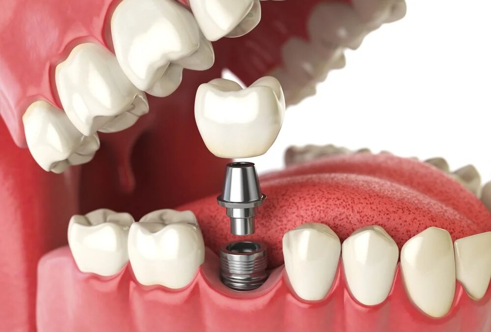 Why Choose Dental Implants Over a Traditional Fixed Bridge?