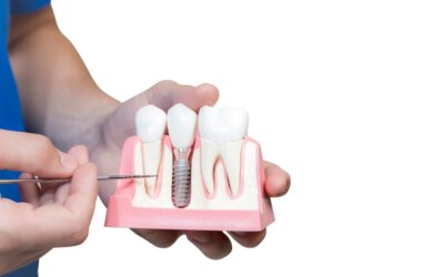 The Timeline of a Dental Implant Surgery in Detail