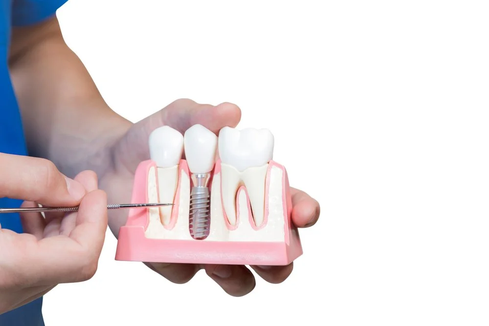 Dental implants OKC