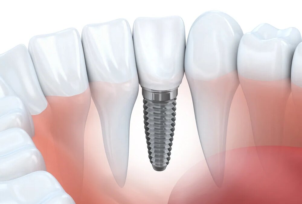 Dental Implant Help You to Keep Natural Teeth Longer