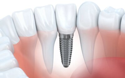 Dental Implant Help You to Keep Natural Teeth Longer