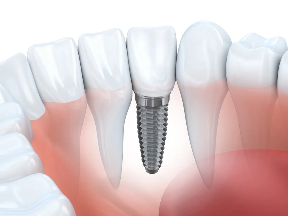 Dental Implant Help You to Keep Natural Teeth Longer