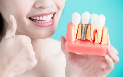 Various Reasons Why You Should Choose Dental Implants for You