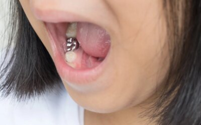 What Should You Know About Permanent Dentures?