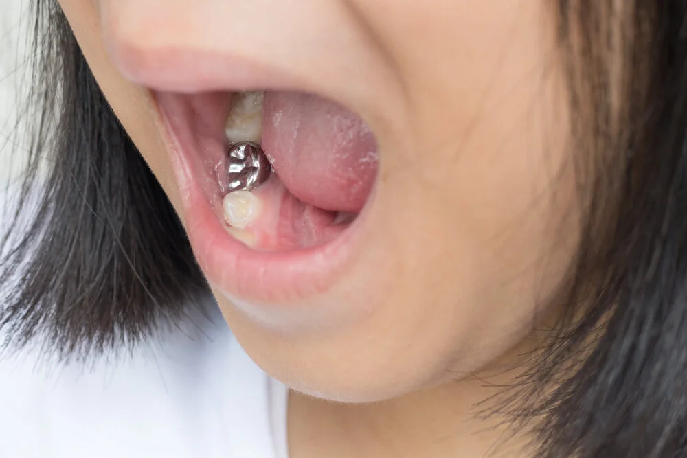 What Should You Know About Permanent Dentures?