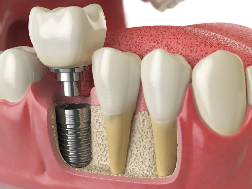 Dental implants procedure