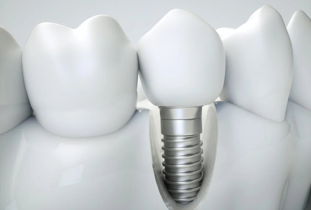 4 Mind-Boggling Dental Implant Benefits to Decipher