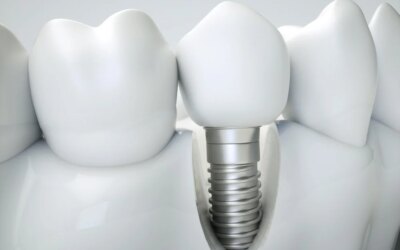 4 Mind-Boggling Dental Implant Benefits to Decipher