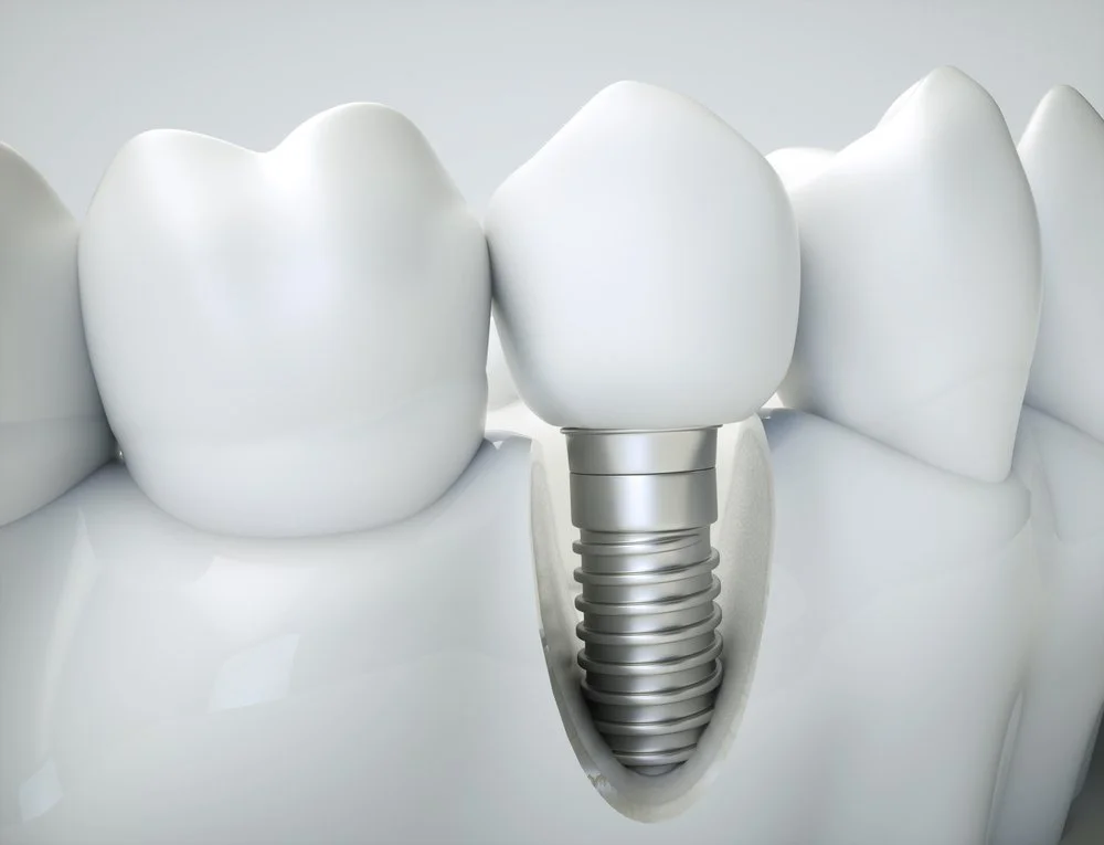 Dental implants in Oklahoma City