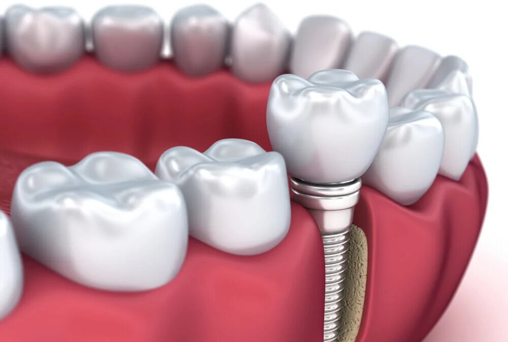5 Benefits That Dental Implants Give You