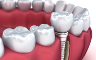 5 Benefits That Dental Implants Give You
