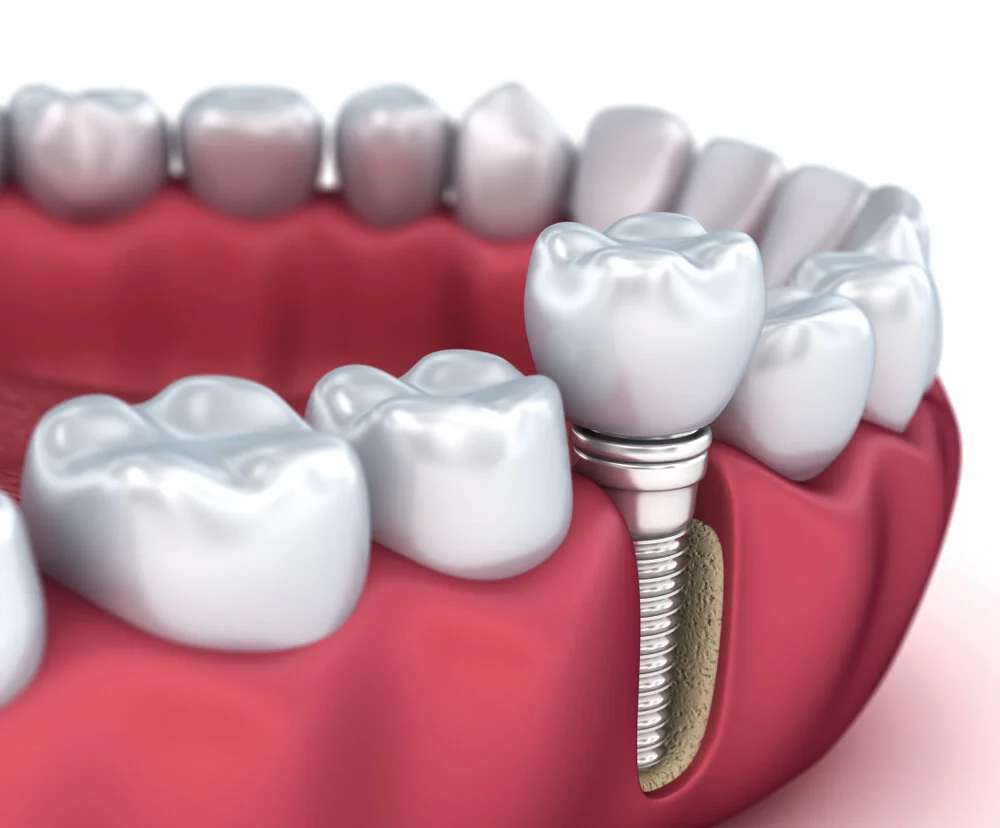 5 Benefits That Dental Implants Give You