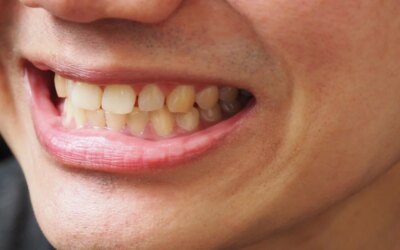 Pulling Out the Underlying Cause of Stained Teeth