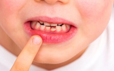 Taking Care of Baby Teeth Is Important