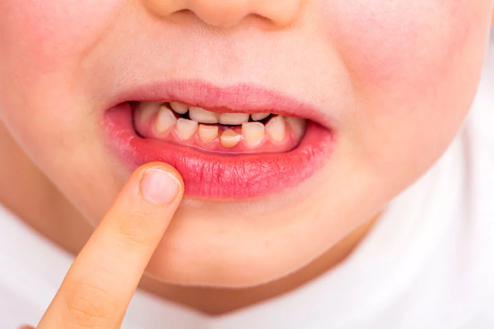 Taking Care of Baby Teeth Is Important
