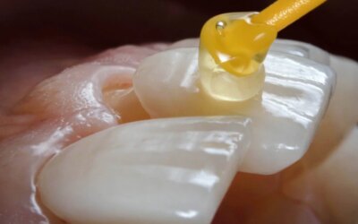 The Ways Porcelain Veneer Can Help Teeth Appearance