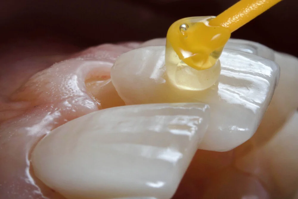 The Ways Porcelain Veneer Can Help Teeth Appearance