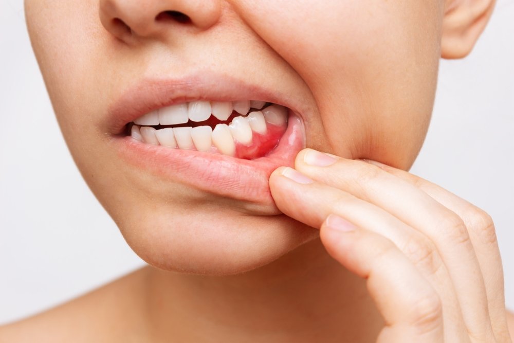 Close-up showing irritated gums