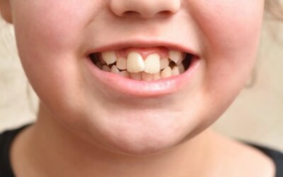 Crooked Teeth: Causes and Treatment Options