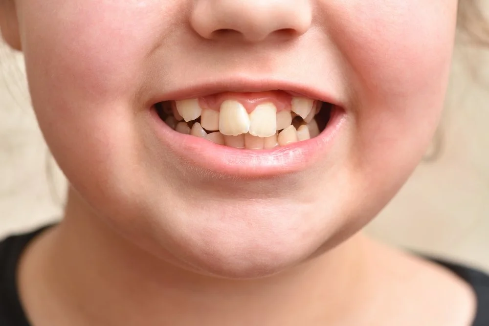 Crooked Teeth: Causes and Treatment Options