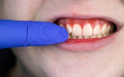 Bleeding Gum Signs: 4 Common Yet Effective Reasons