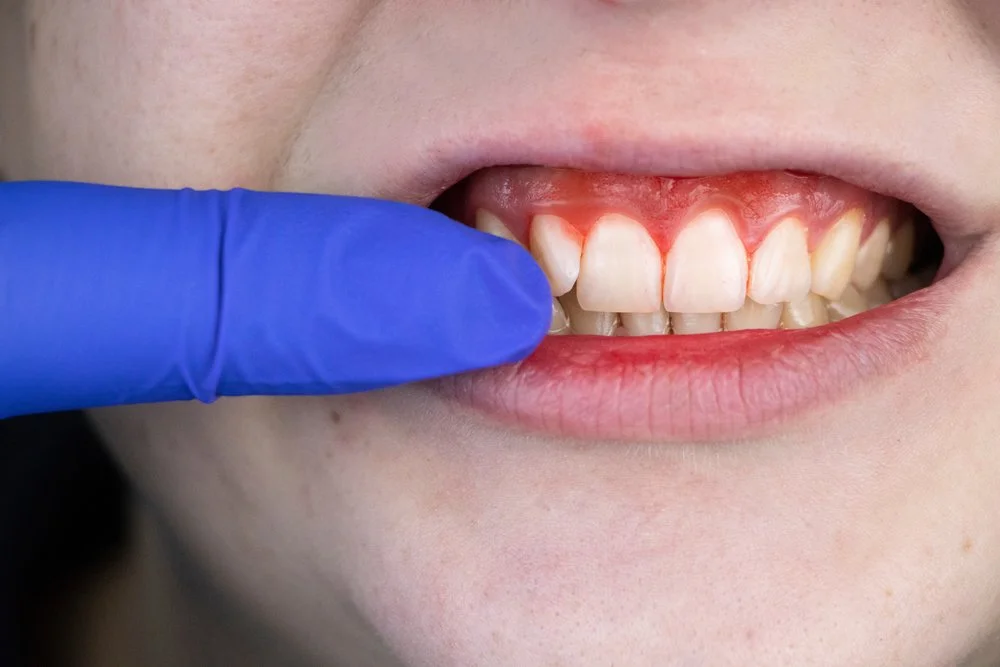 Bleeding Gum Signs: 4 Common Yet Effective Reasons