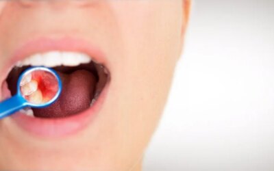 Probiotics – Are They Good for Oral Health?