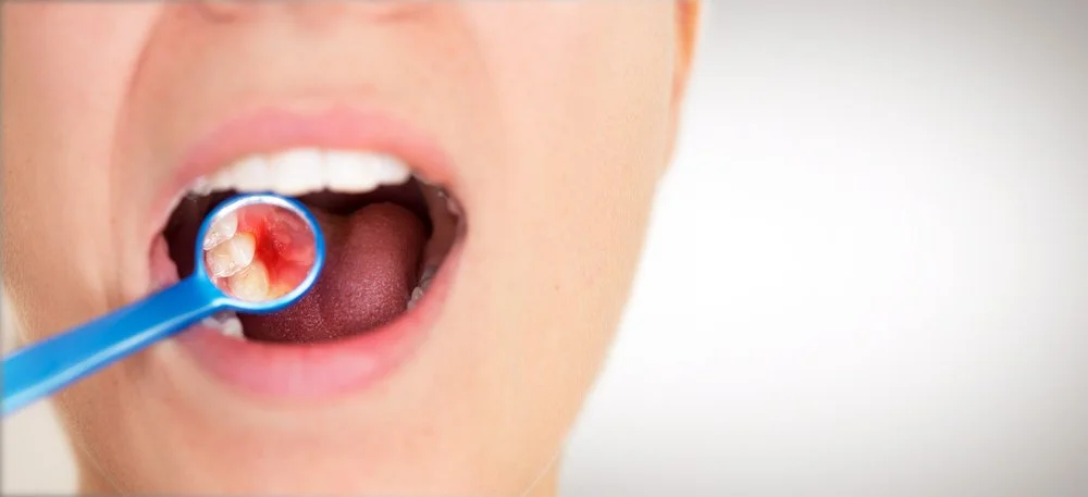 Probiotics – Are They Good for Oral Health?