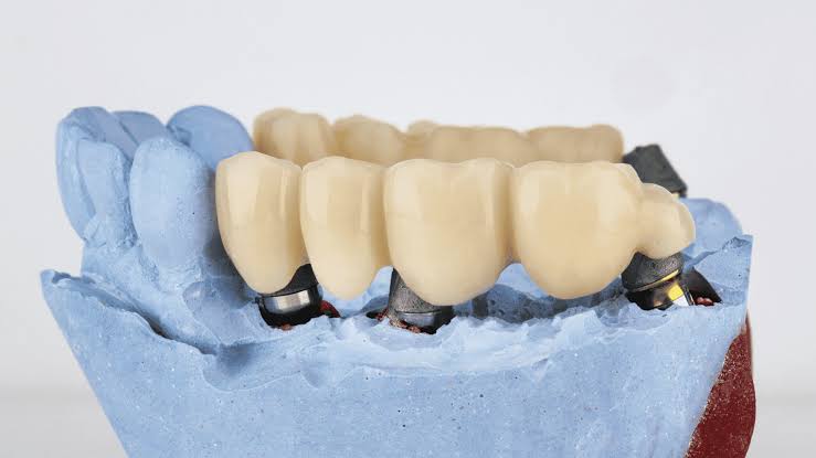 Dental bridge restoration