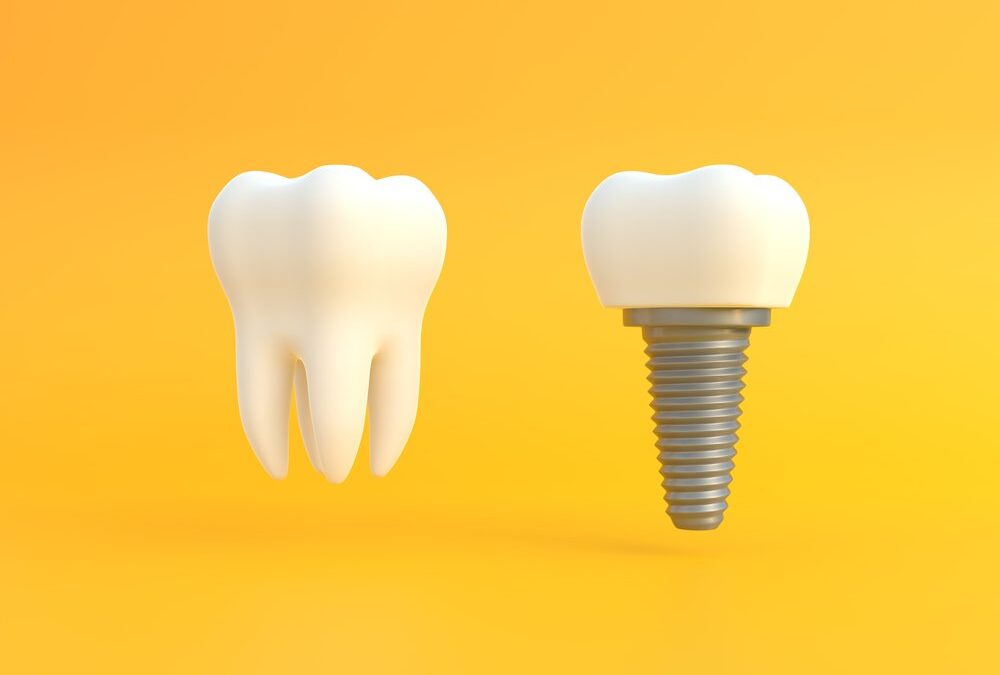 5 Most Searched Frequently Asked Questions About Dentures