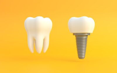 5 Most Searched Frequently Asked Questions About Dentures