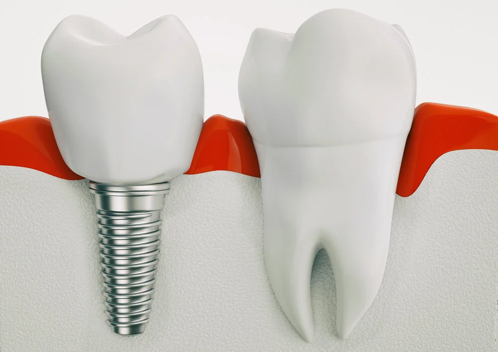 Permanent dentures