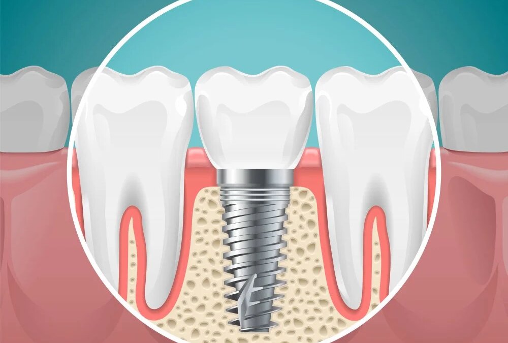 Are You Wearing Your Dentures Whole Night?