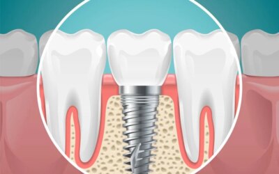 Are You Wearing Your Dentures Whole Night?