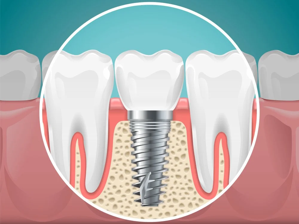 Are You Wearing Your Dentures Whole Night?