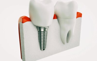 Knowing the Basic Difference between Permanent and Temporary Dentures