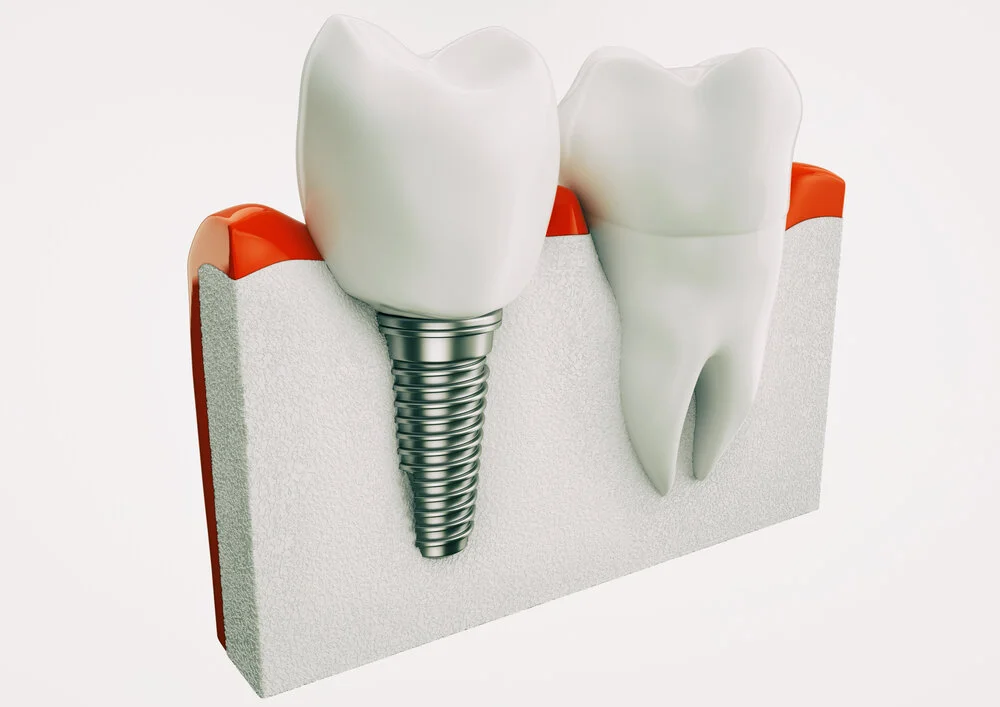 Knowing the Basic Difference between Permanent and Temporary Dentures