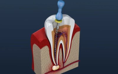 Why Do You Need a Root Canal?